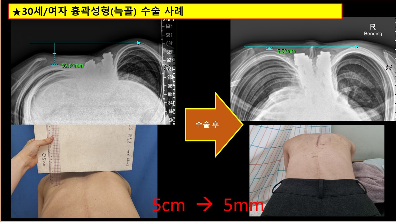 진료실이야기 30세 여성 흉곽 성형늑골성형 사례입니다 