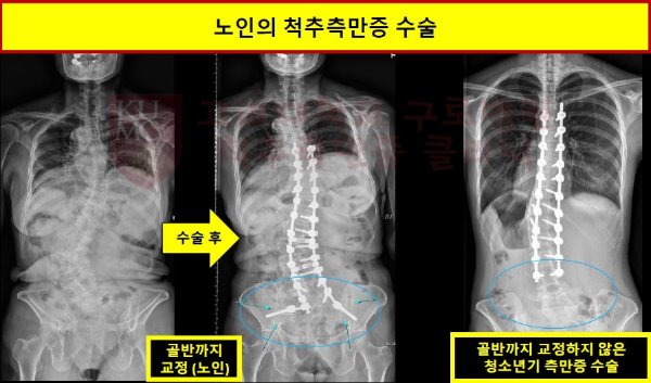 노인의_척추측만증_수술.JPG