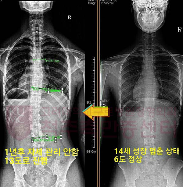 척추측만증_20161215_5 copy.jpg