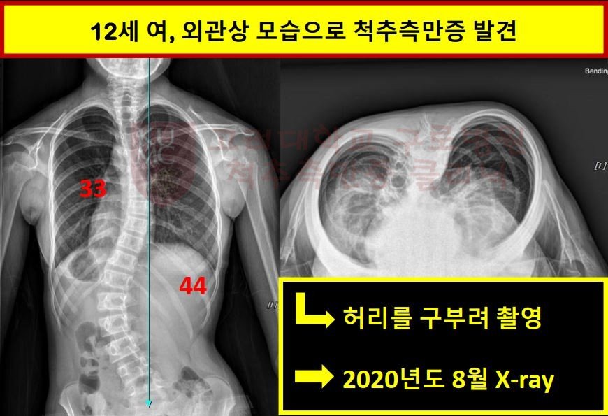 외관상 모습으로 척추측만증 발견.jpg