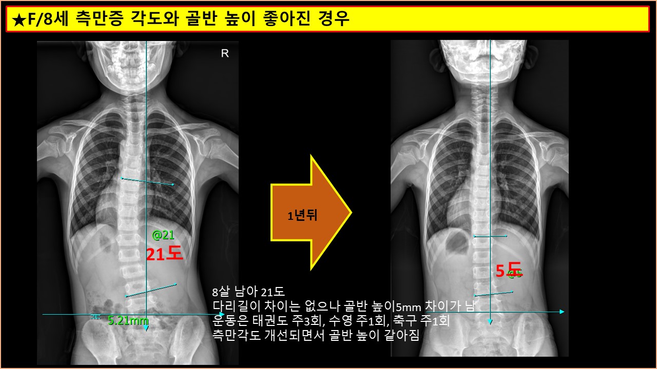 측만증각도 골반높이 개선 사례.jpg