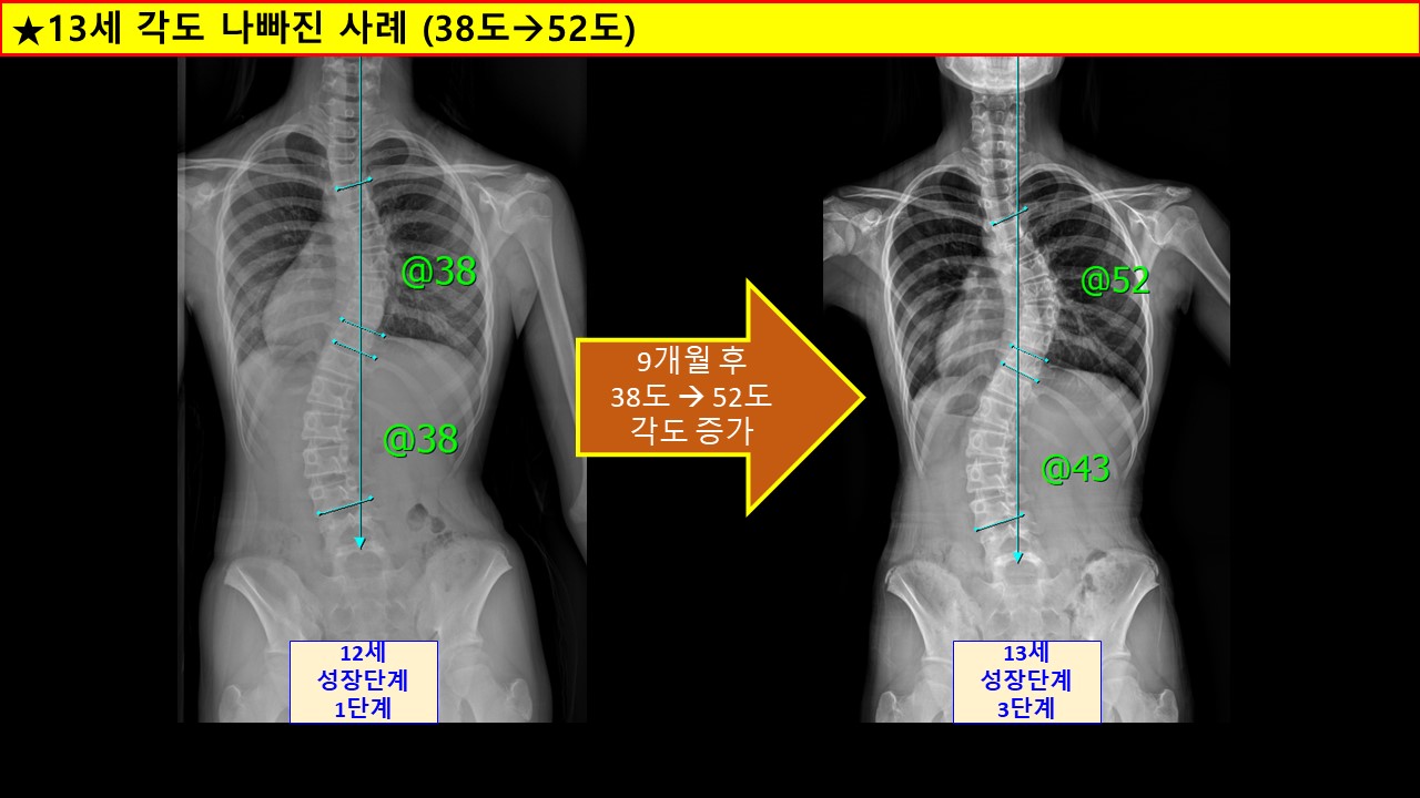 13세 각도나빠진사례.jpg
