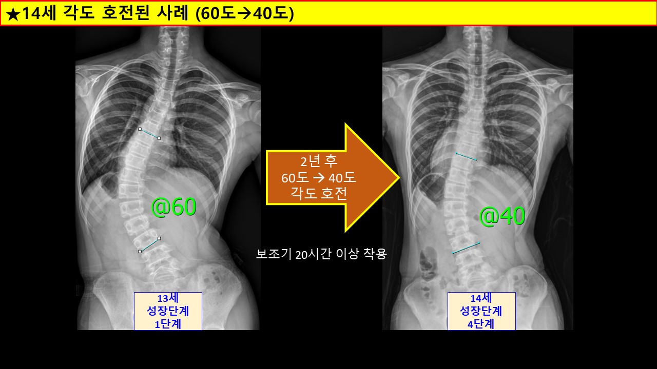 각도좋아진사례 14세.jpg