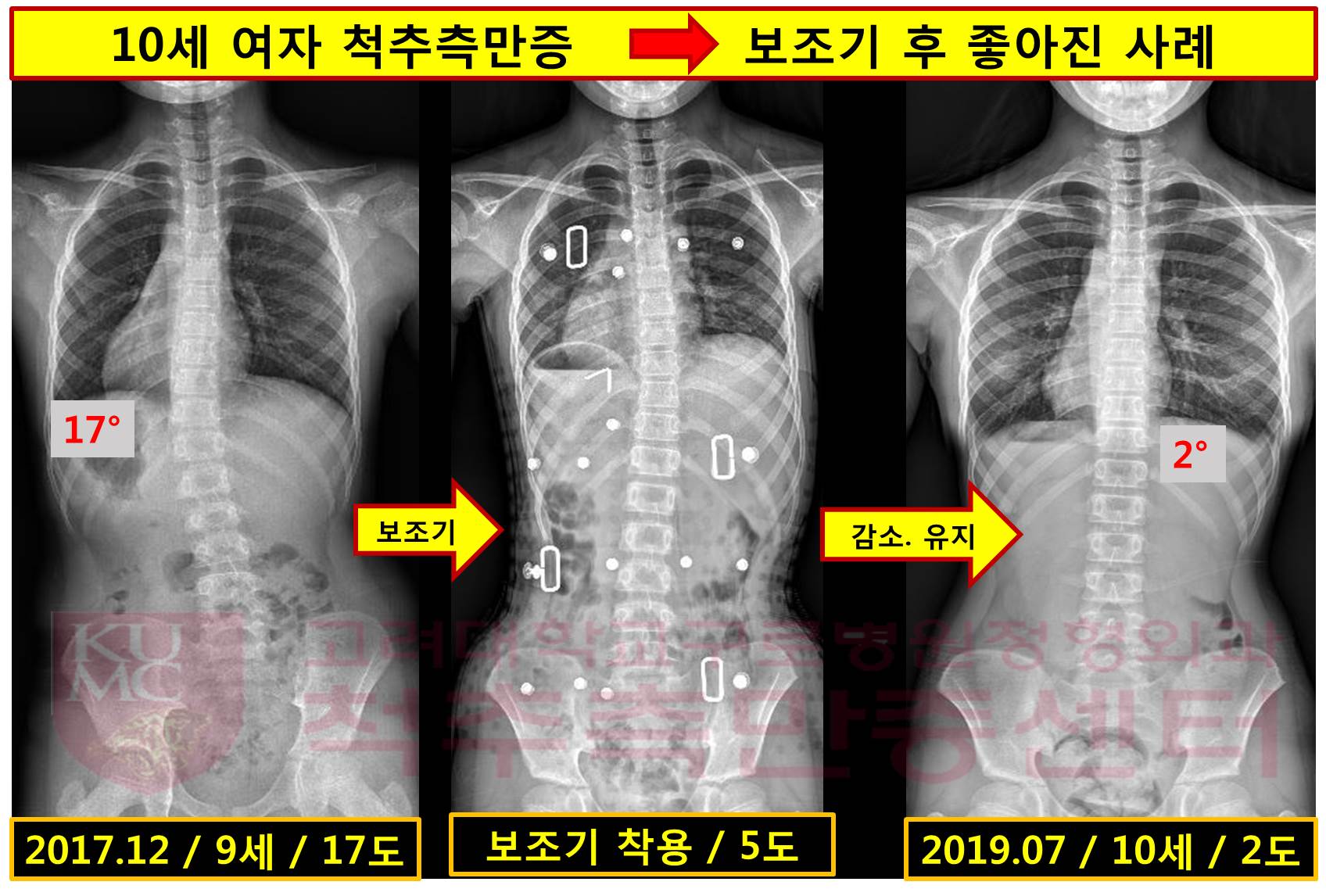 53. 보조기 후 좋아진 사례.jpg