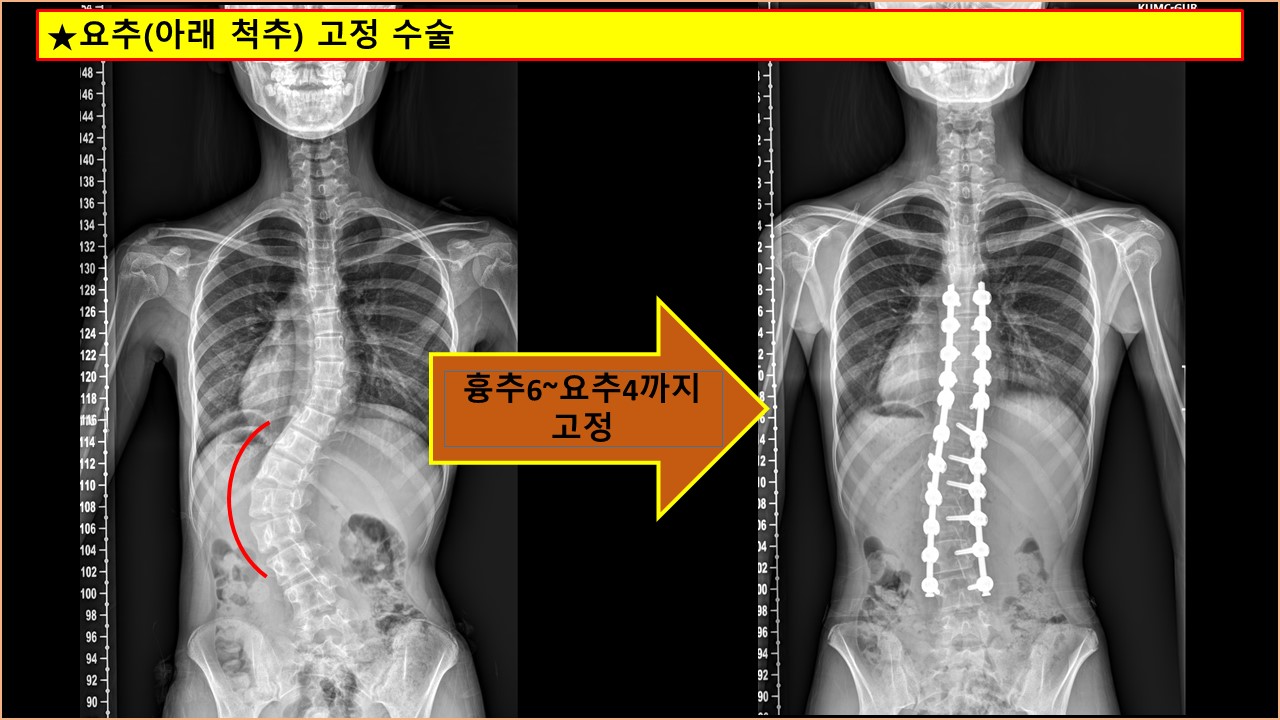 수술 고정 부위 3.jpg