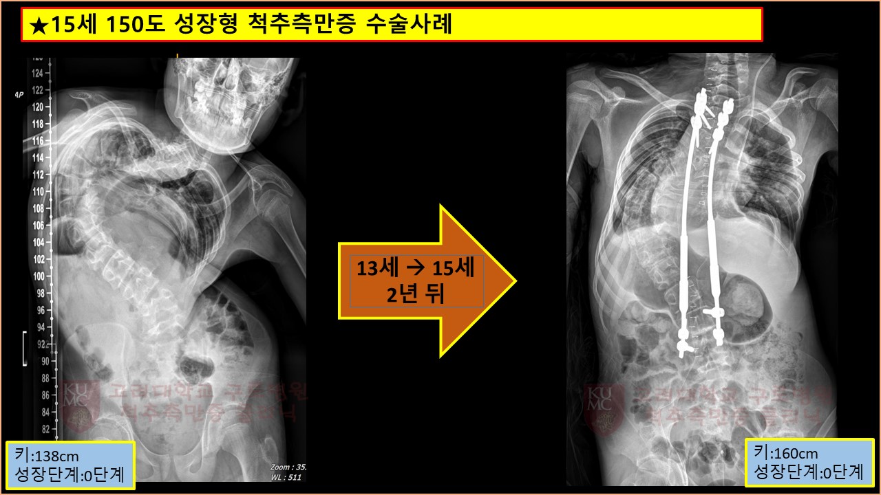 성장형 수술 1.jpg