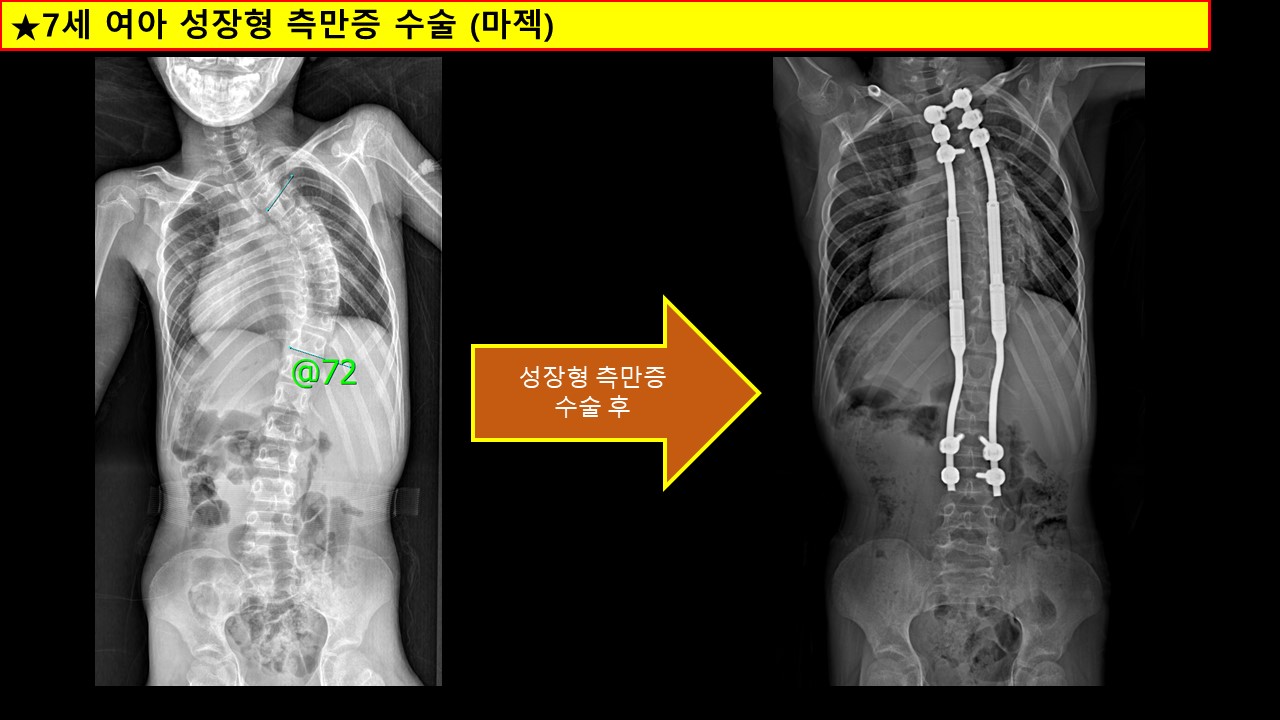 성장형 마젝 수술.jpg