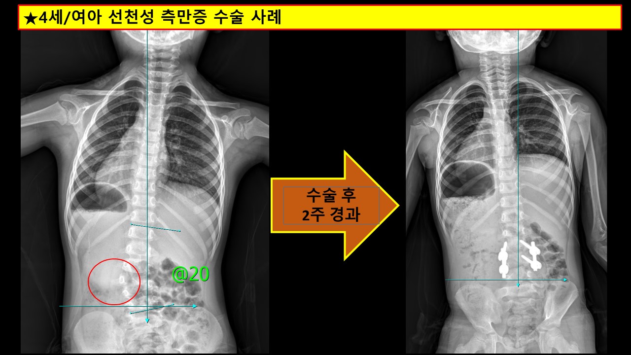 진료실이야기. 선천성 척추측만증.jpg