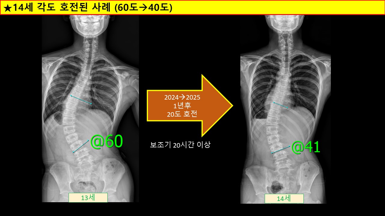 60-40호전 14세.jpg