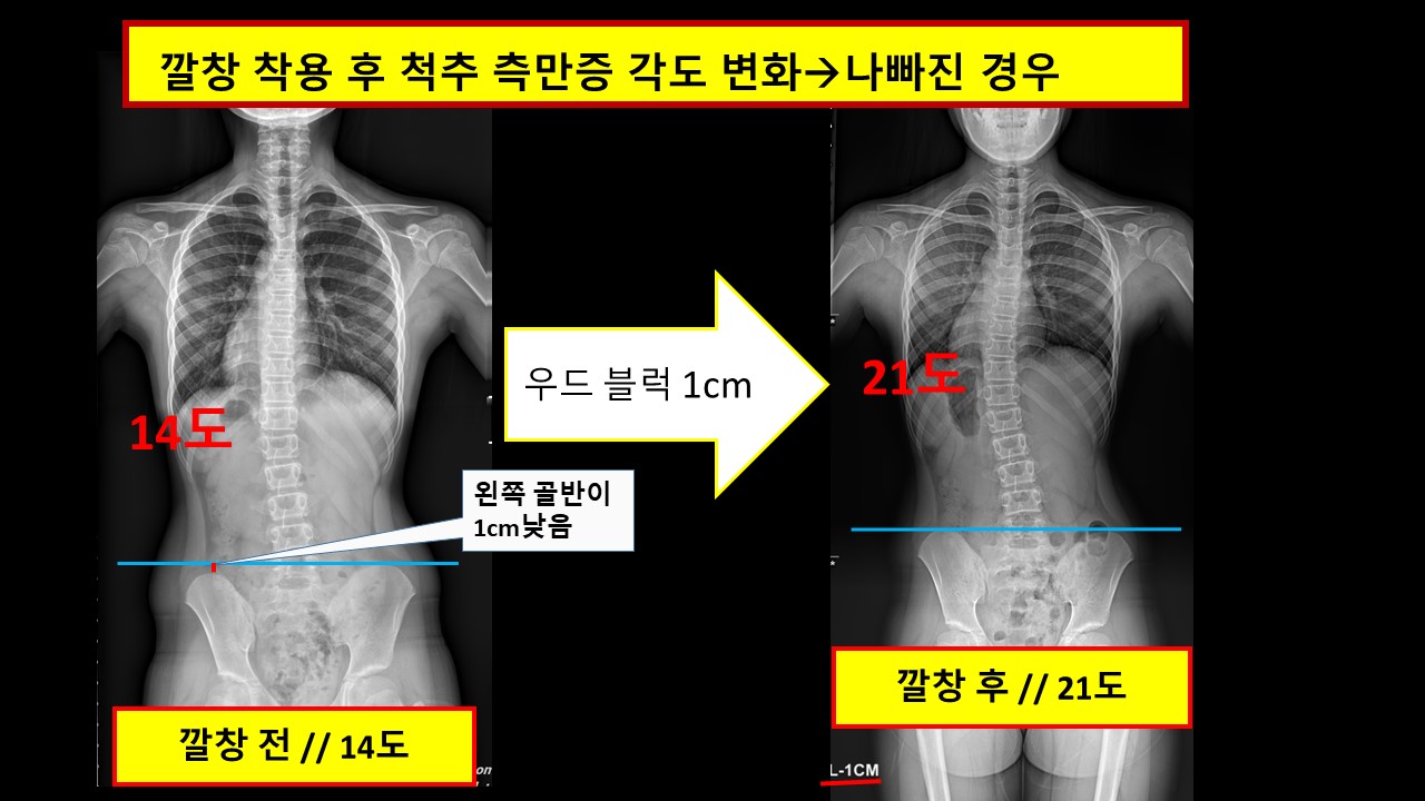 깔창 후 나빠짐 -.jpg