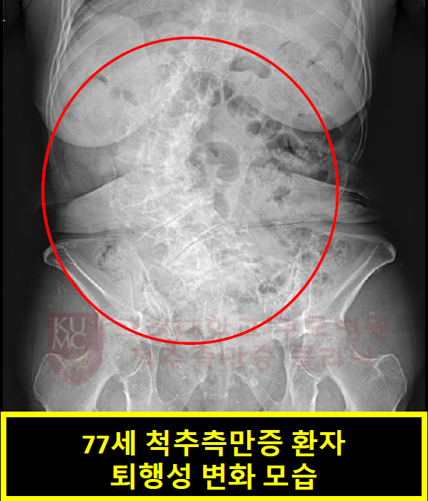 측만증 퇴행성 환자.png