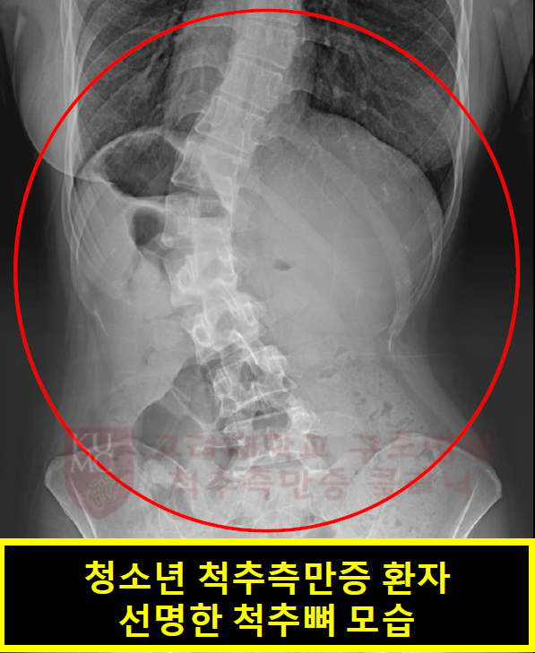 성장기 측만증.png