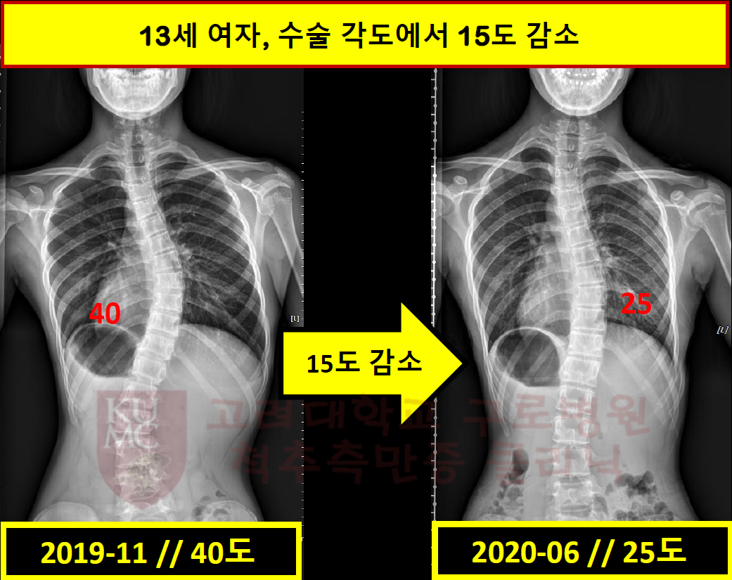 13세 여자, 수술 각도에서 15도 감소.PNG