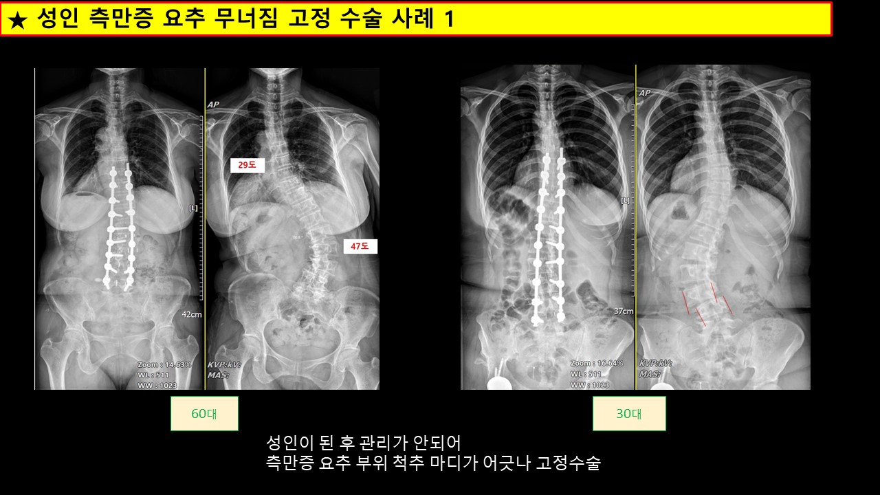 고려대 척추측만증센터 - 성인 측만증 요추 무너짐 고정 수술 사례 1